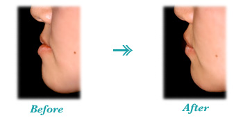 ���{�O�ˁA���Ό������i�󂯌��j�摜